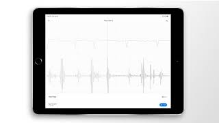 Atrial Fibrillation Combined Heart Sound PCG amp ECG Example  EkoCLINIC App [upl. by Thorlay106]