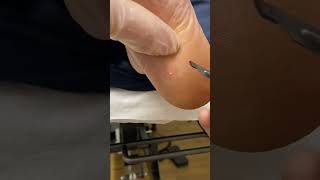 Expert Australian Podiatrist Removes Painful Corns with Precision [upl. by Helge184]