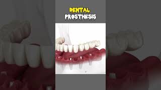 Dental Prosthesis Implant teethcleaning teethwhitening dentist laser treatments youtube teeth [upl. by Daffi]