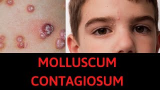 What is Molluscum Contagiosum Symptoms Treatment [upl. by Whiffen]