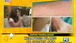 Keratosis Pilaris or Chicken Skin [upl. by Wasson]