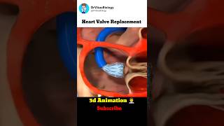 Heart Valve Replacement Procedure 👨‍⚕️ [upl. by Trebliw406]