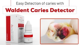 Easy Detection of Caries with Waldent Caries Detector [upl. by Odraleba]