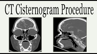 CT cisternogram procedure [upl. by Marilee]