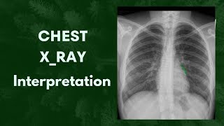 What is this called Chest X ray Interpretation 🤔anatomy youtube radiology [upl. by Bohaty969]