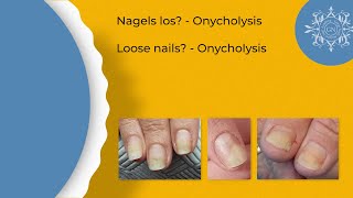 RELEAF amp RECOVERY for nail plate separation from the nail bed [upl. by Titos]