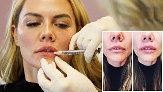 Natural Lip Injection Experience and Botox from Doctor Cynthia Cote [upl. by Arraik]