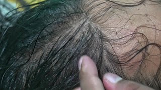 Lice and Nits Damage my Hair  Lice Picking and Popping with Nails [upl. by Akino]