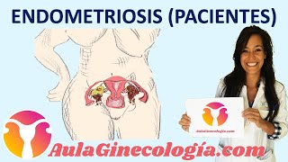 ENDOMETRIOSIS PACIENTES Síntomas diagnóstico tratamiento fertilidad Ginecología y Obstetricia [upl. by Grimaldi]