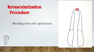 Revascularization procedure in open apex cases [upl. by Enytsuj307]