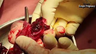 Ectopic Pregnancy Laparotomy 02 03 2024 [upl. by Leunam]