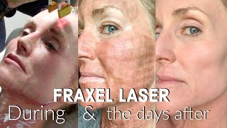 My FRACTIONAL CO2 LASER Experience  The FULL Treatment amp the DAYS following  BEFORE amp AFTER Fraxel [upl. by Elcin]