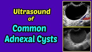 Ultrasound of Common Adnexal Cysts [upl. by Figueroa693]