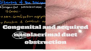 Congenital and acquired nasolacrimal duct obstruction  CNLO  ANLO [upl. by Jessamyn]