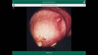 Neisseria gonorrhoeae [upl. by Fulbert]