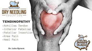 Tendinitis and Tendinopathy Dry Needling Treatment Protocol [upl. by Kyne]