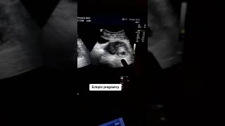 Ectopic pregnancy Positive 7 weeks [upl. by Kcirtap]