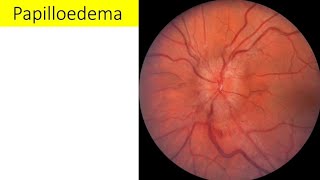 Lacture  Papilloedema explained [upl. by Lleda]