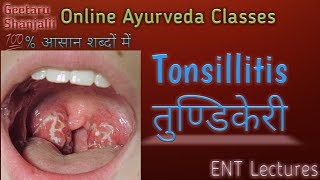 Tonsillitis or तुण्डिकेरी [upl. by Diahann]