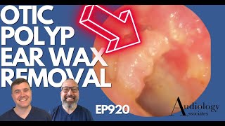 OTIC POLYP EAR WAX REMOVAL  EP920 [upl. by Remmus]