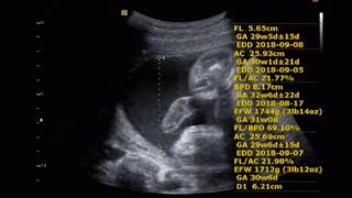 fetal ultrasound of 30 weeks baby boy moving [upl. by Little]