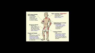 🧶 Haemophilia clinical features [upl. by Taber585]