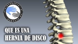 Hernia discal que es y como se produce [upl. by Baker]