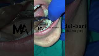 extraction of malposed lower second premolar using forceps [upl. by Whitnell862]