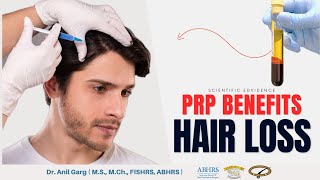 Control Hair Fall with PRP Treatment  Before amp After Result  Benefits of PRP [upl. by Ettenyl]