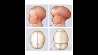 Craniosynostosis II የህፃናት የጭንቅላት አጥንት ቀድሞ መዘጋት II Dr Temesgen Shume [upl. by Waring92]