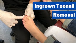 Ingrown Toenail Removal Surgery Video  Permanent Cosmetic Procedure [upl. by Aikym415]