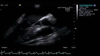 TEE  Mitral Valve involvement of APLS [upl. by Raul]