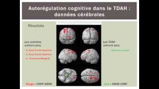 Corrélats cérébraux de lautorégulation cognitive dans le TDAH [upl. by Ynoyrb]