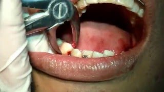 HUETEDENTAL Exodoncia de Premolares inferiores  34 y 44  Dr Rigoberto Huete [upl. by Merdith]