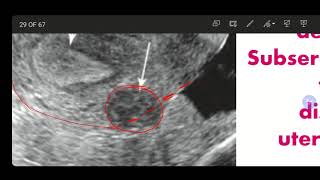 Ultrasound of Fibroids  Sonographic Appearance of Fibroids  Fibroids Differential Diagnosis [upl. by Leatrice454]