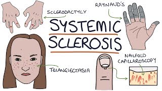 Systemic Sclerosis and Scleroderma Visual Explanation for Students [upl. by Ettesil]