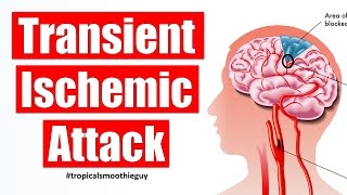 How A Transient Ischemic Attack Affects Your Brain [upl. by Lenrow]