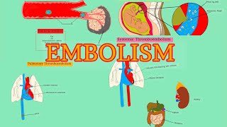 Pathology 18HDD 4  EMBOLISM  Pulmonary thromboembolism  Systemic thromboembolism AfSoomaali [upl. by Penthea]