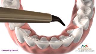 Orthodontics Retainer  Bonded or Permanent [upl. by Mckay]