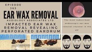 IMPACTED EAR WAX REMOVAL REVEALING PERFORATED EARDRUM EP363 [upl. by Sel]