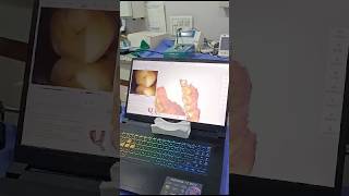 Intraoral Scanner  Zirconia Crowns  Dental Experts  Dr Brijesh Byrappa [upl. by Lewin]