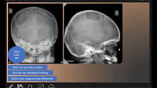 OSCE Case 004  Eosinophilic granuloma [upl. by Guthrey]