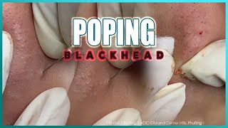 Big Cystic Acne Blackheads Extraction Blackheads amp Milia Whiteheads Removal Pimple Popping [upl. by Shelbi]