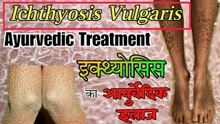 Ichthyosis Vulgaris Ayurvedic Treatment  Fish Scale Disease  Dr Mohammad Azam  इक्थ्योसिस [upl. by Pamela]