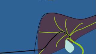 Biliary Stenting [upl. by Esyli40]