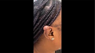 🦻🏾🦻🏾What the hll is that on your ear🙉Helical keloids in Black skin [upl. by Naujik710]