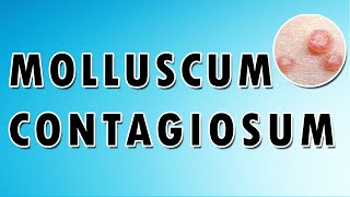 Molluscum Contagiosum Symptoms and Treatment [upl. by Malamud]