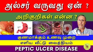 PEPTIC ULCER  SYMPTOMS CAUSES AND TREATMENT IN TAMIL FOODS TO CURE ULCER வயிற்றுப்புண் [upl. by Scherle813]