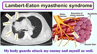 LambertEaton myasthenic syndrome [upl. by Nelrah]