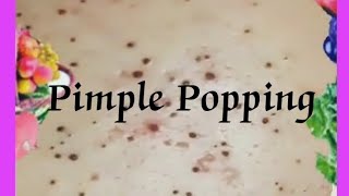 Pimple amp Blackheads Popping  52 [upl. by Costa]